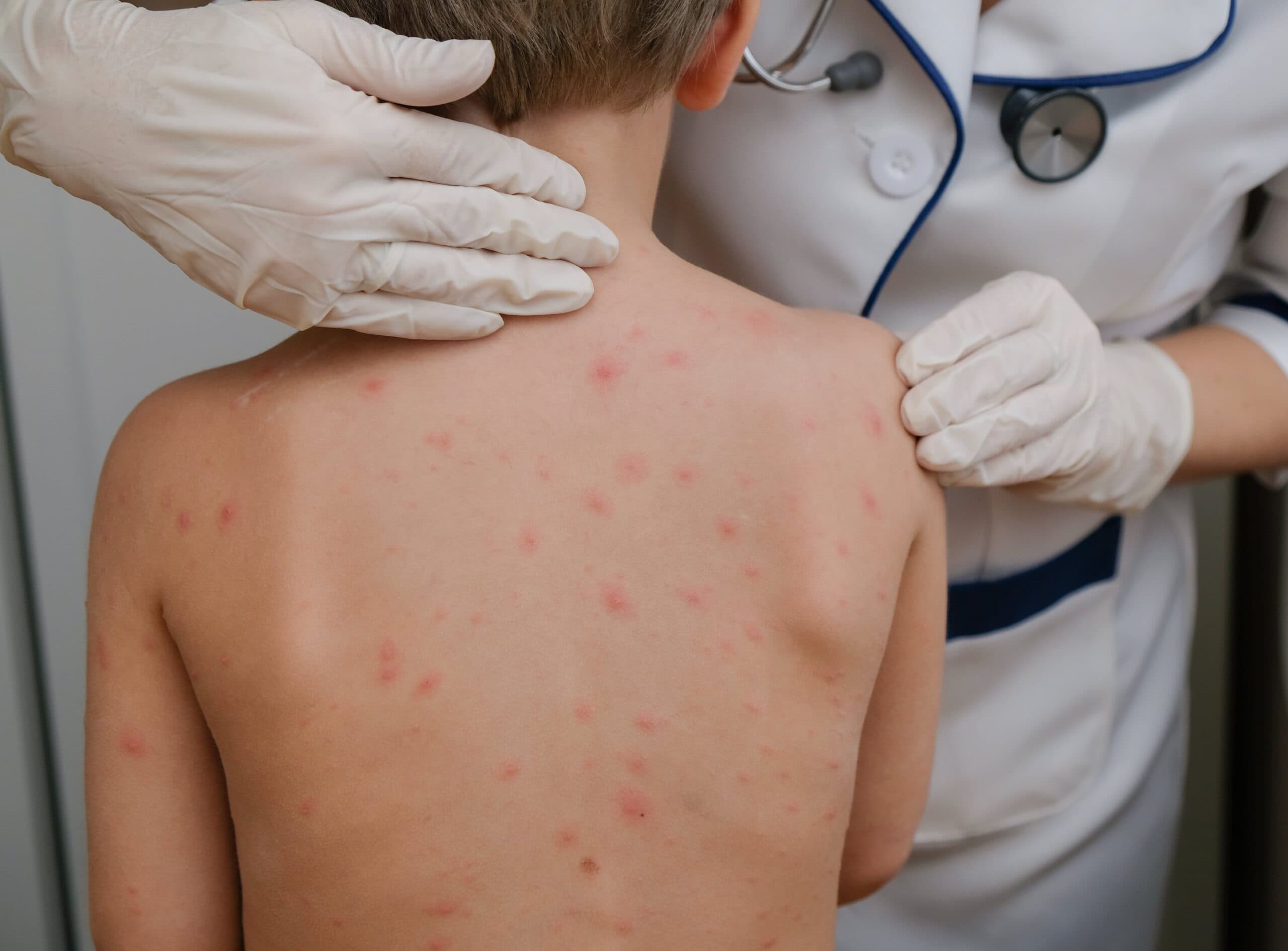 Alerta de la OPS: Aumentar la vacunación ante brote de sarampión